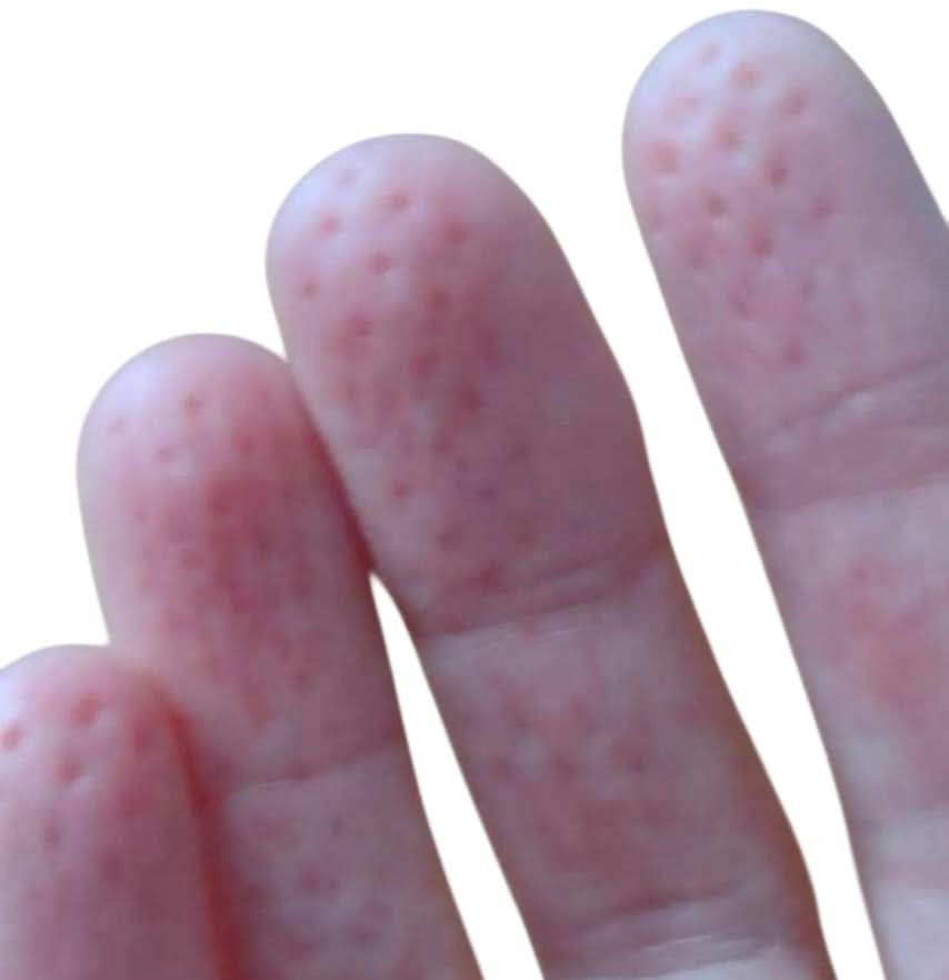 Spikeyring with Dual Pads